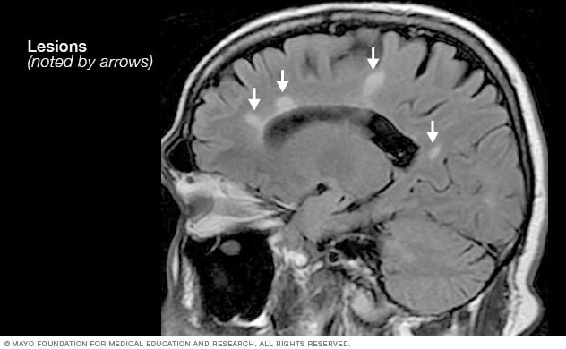 Essential Guide to How to Test for MS at Home: Discover Reliable Methods and Resources for Accurate Results in 2025