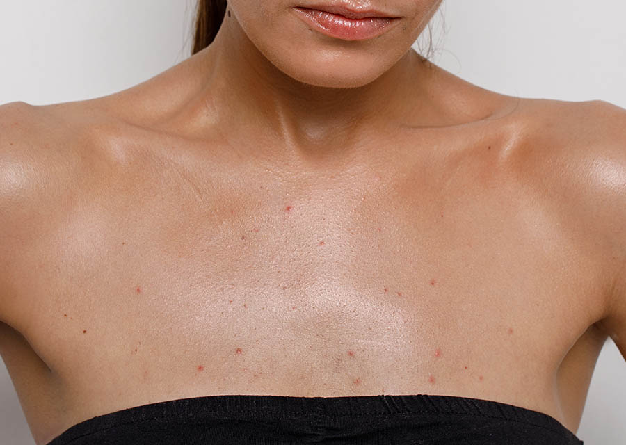 Top 5 Methods for Getting Rid of Chest Acne in 2025: Improve Your Skin Today!