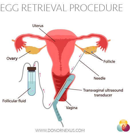 Effective Ways to Donate Eggs: A Complete Guide for Interested Donors in 2025