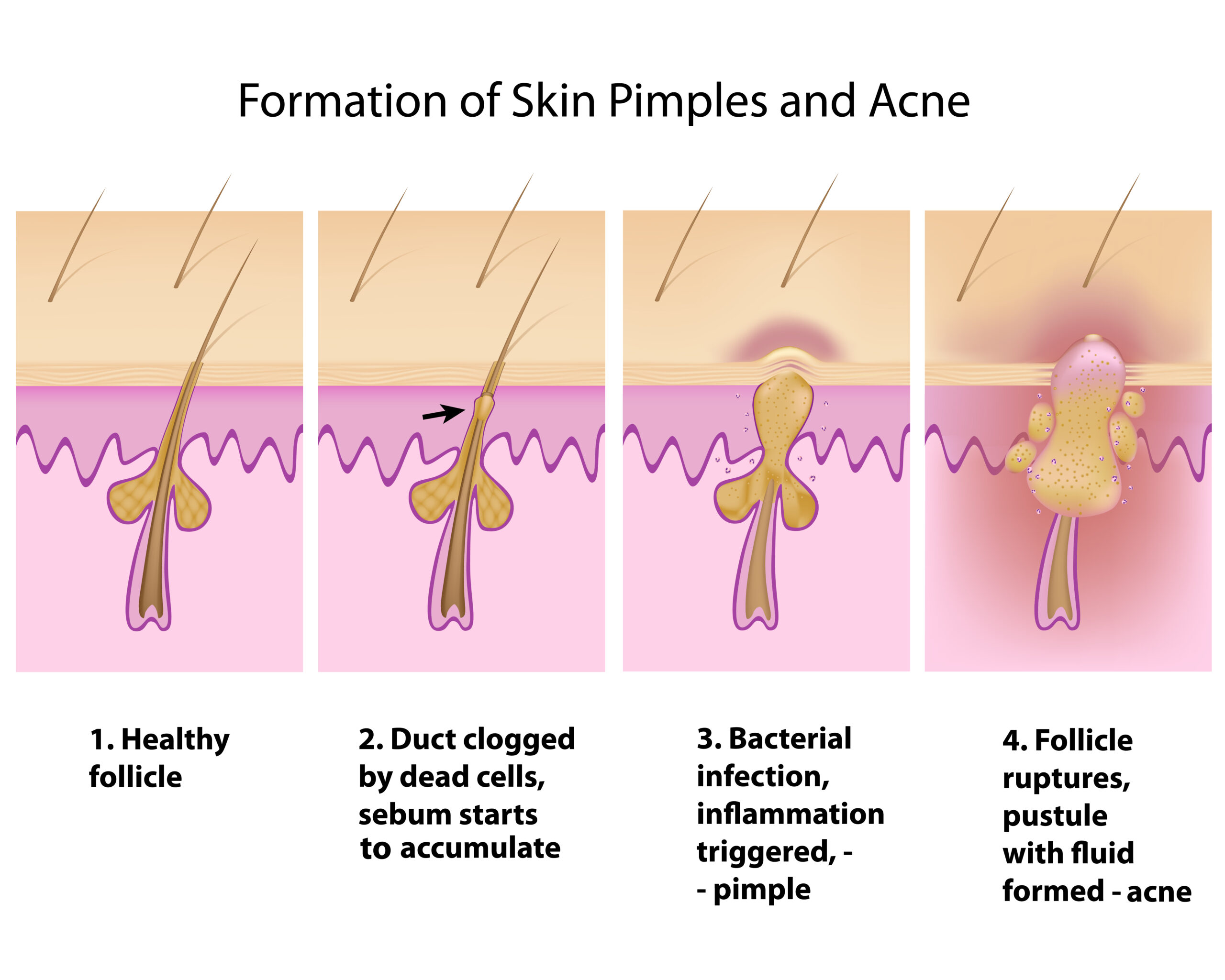 How to Effectively Remove Pimples Overnight: Proven Tips for Clear Skin in 2025