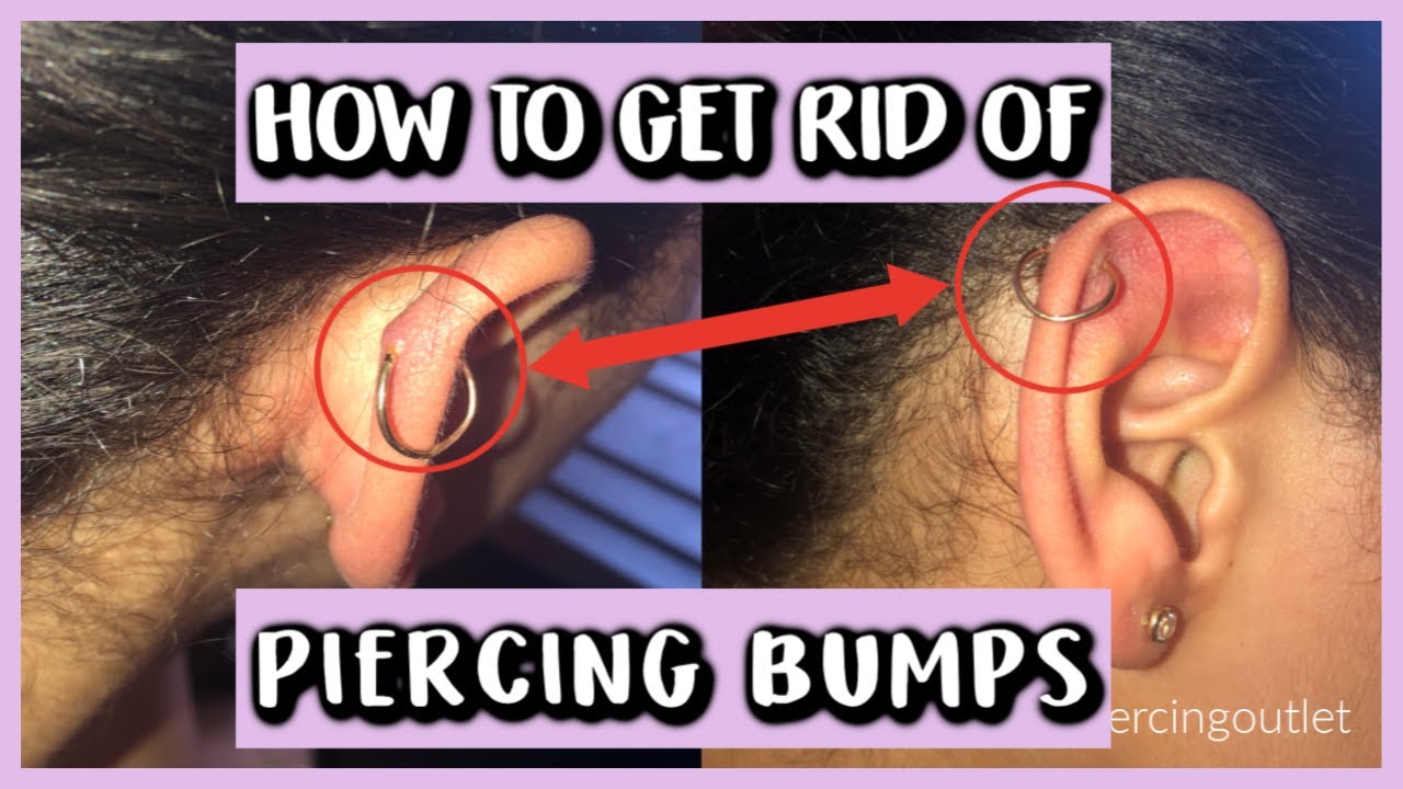 How to Effectively Get Rid of Piercing Bumps: The Complete Guide for 2025