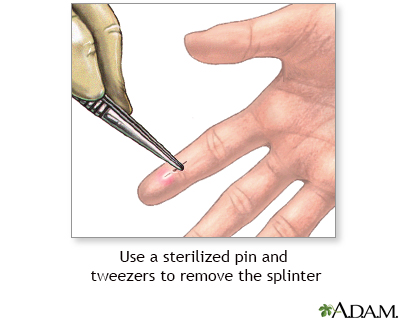 Removing splinters effectively