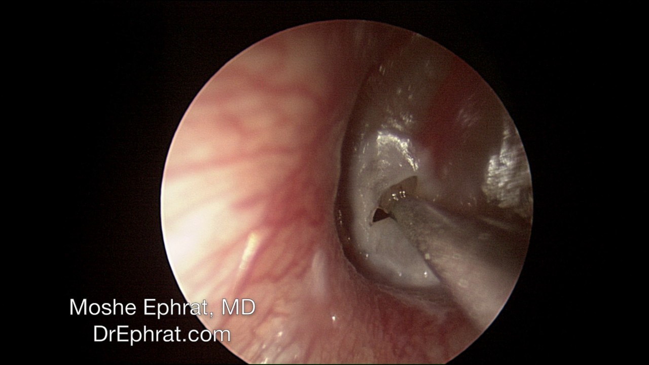 Fluid in Ear Techniques