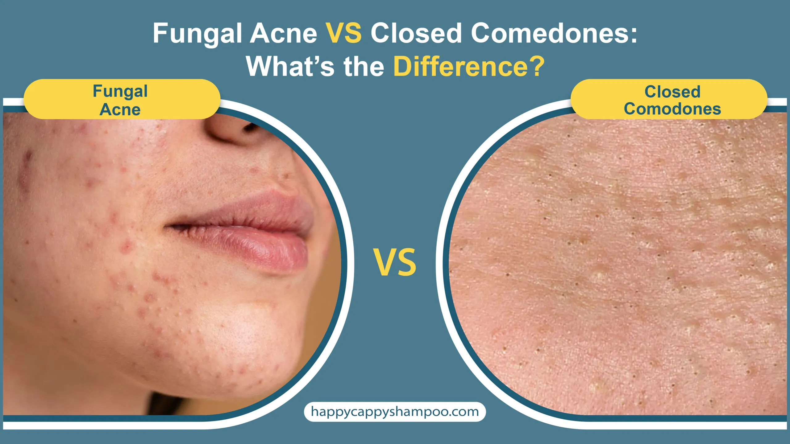 Top 5 Effective Methods for Treating Fungal Acne in 2025: Essential Tips to Succeed